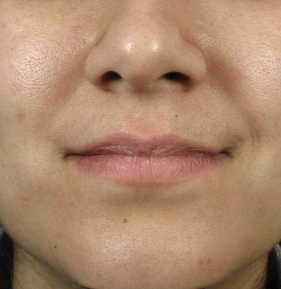 lip fillers london treatment before