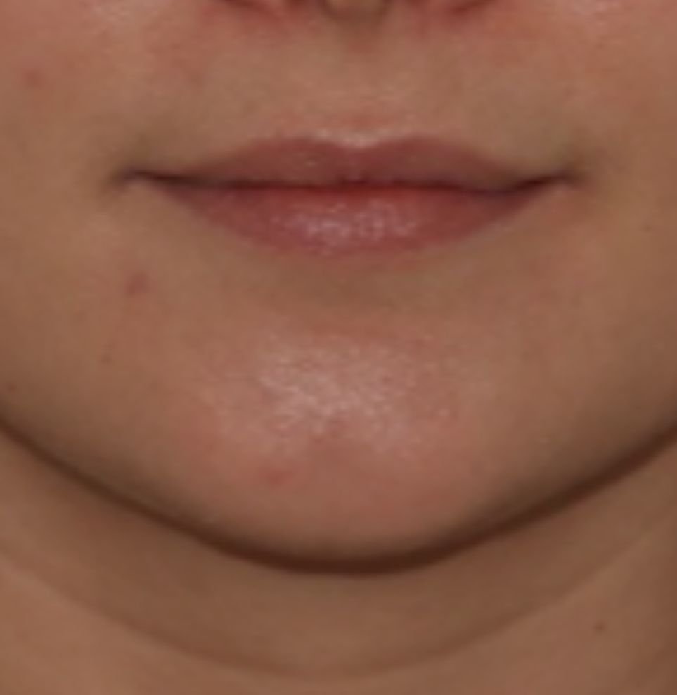 lip fillers london before treatment