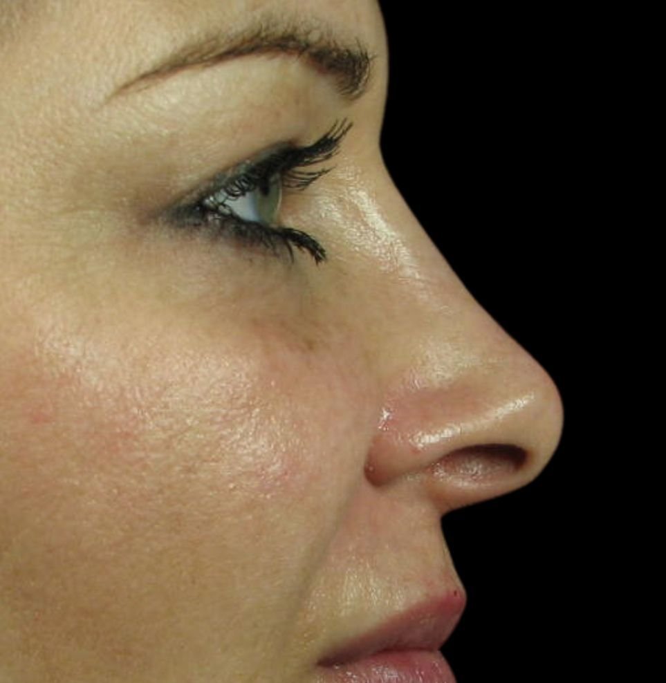 nose filler treatment after