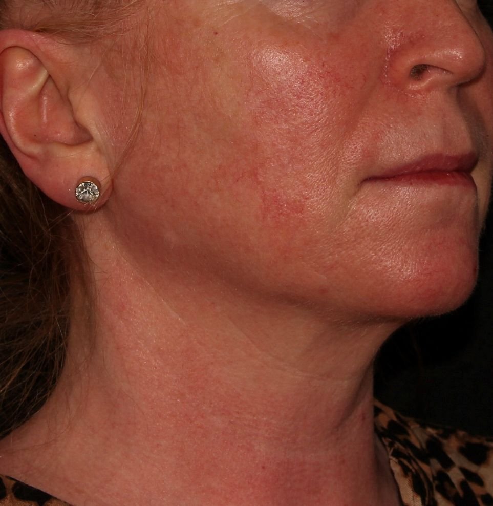 V beam redness before treatment