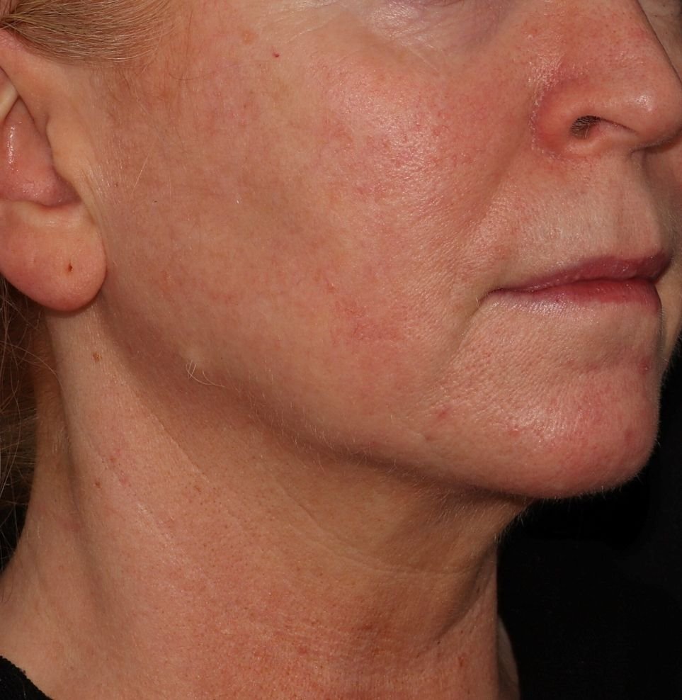 V beam redness after treatment