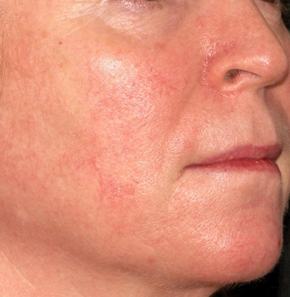 redness phi treatment before