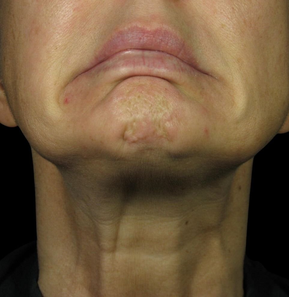 chin botox treatment before