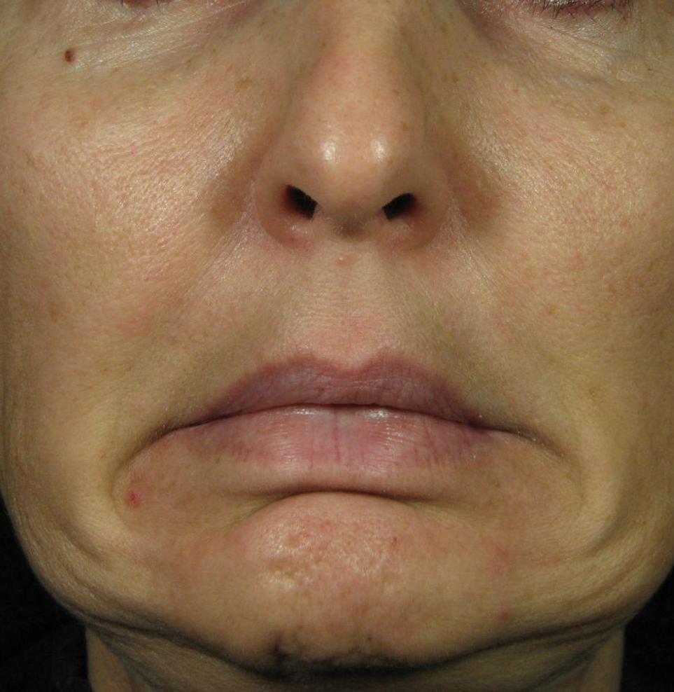 chin botox phi treatment before