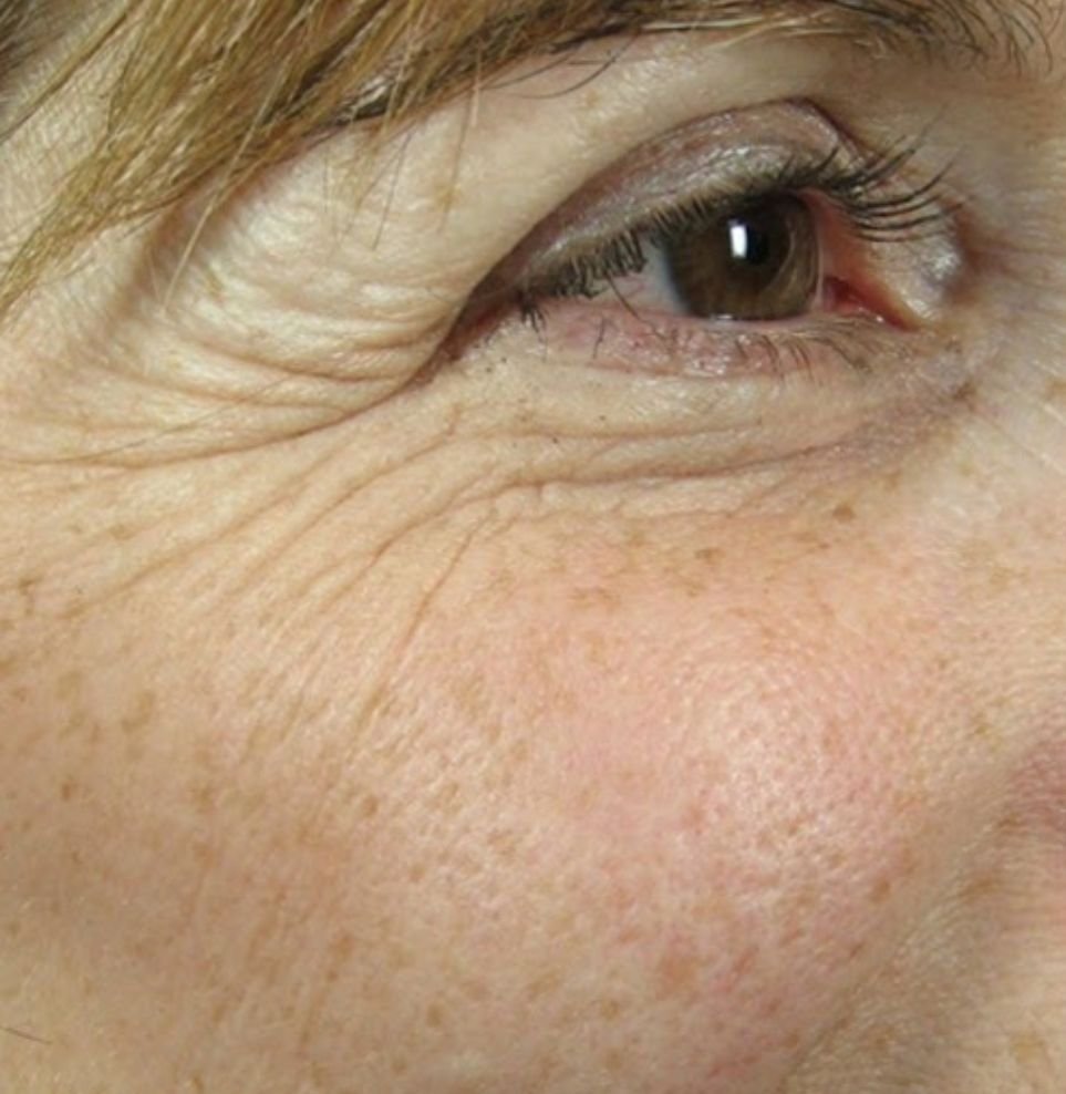 crows feet treatment botox before