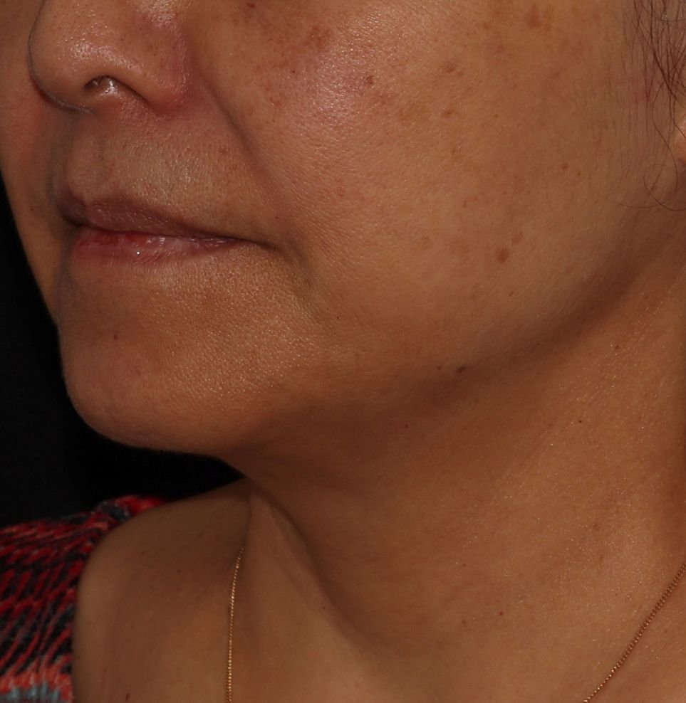 endolift treatment after