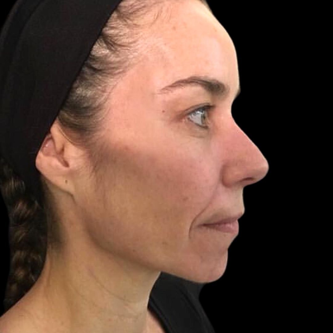 jawline filler treatment after