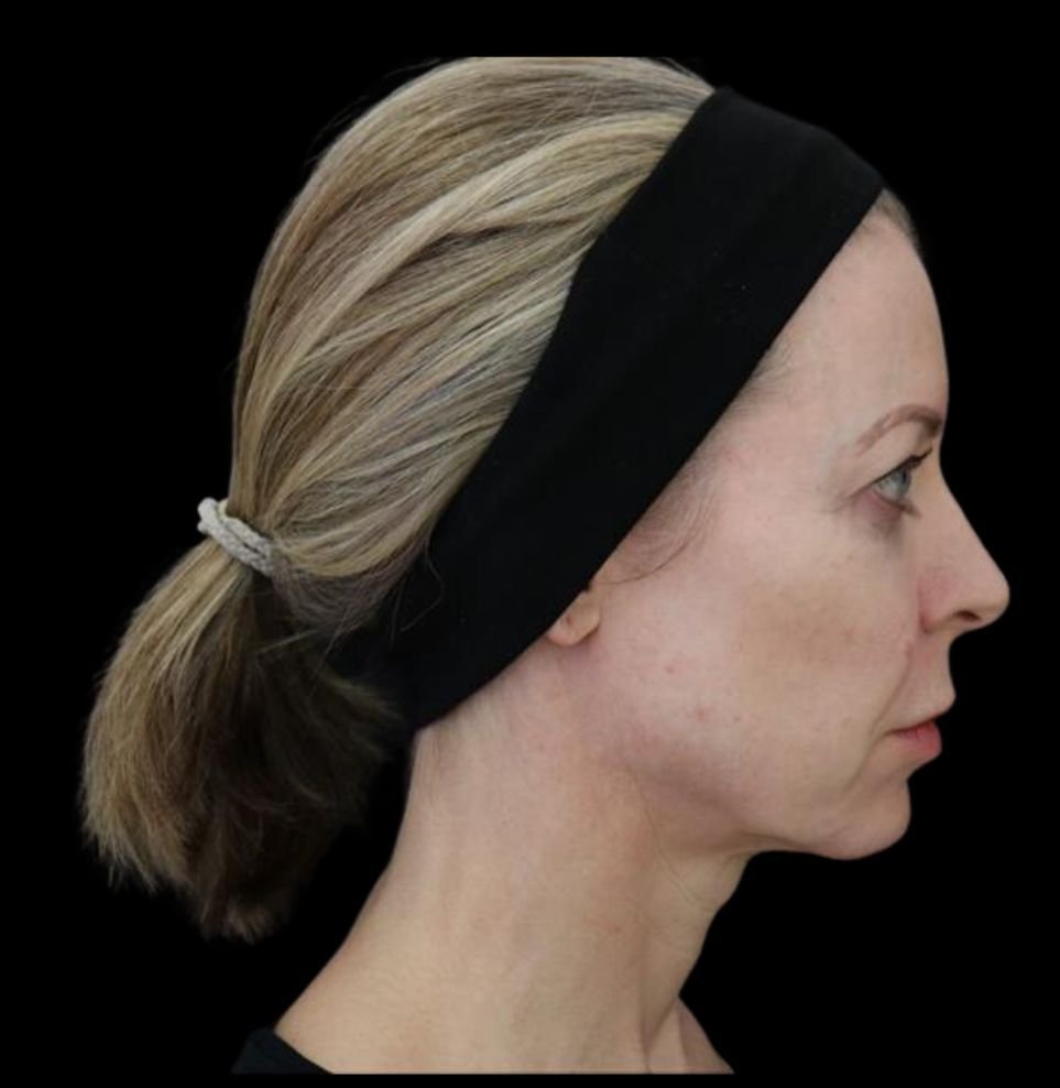 non-surgical facelift before