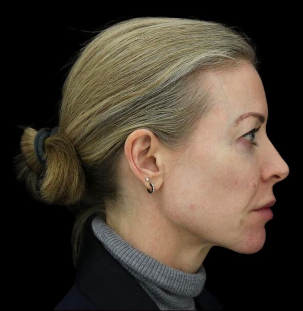 non-surgical facelift after