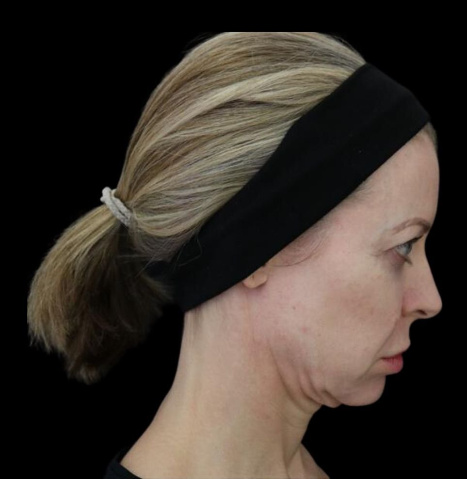 non-surgical facelift before