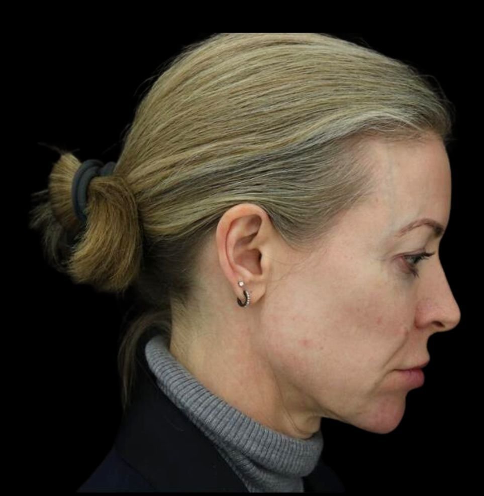 non-surgical facelift after