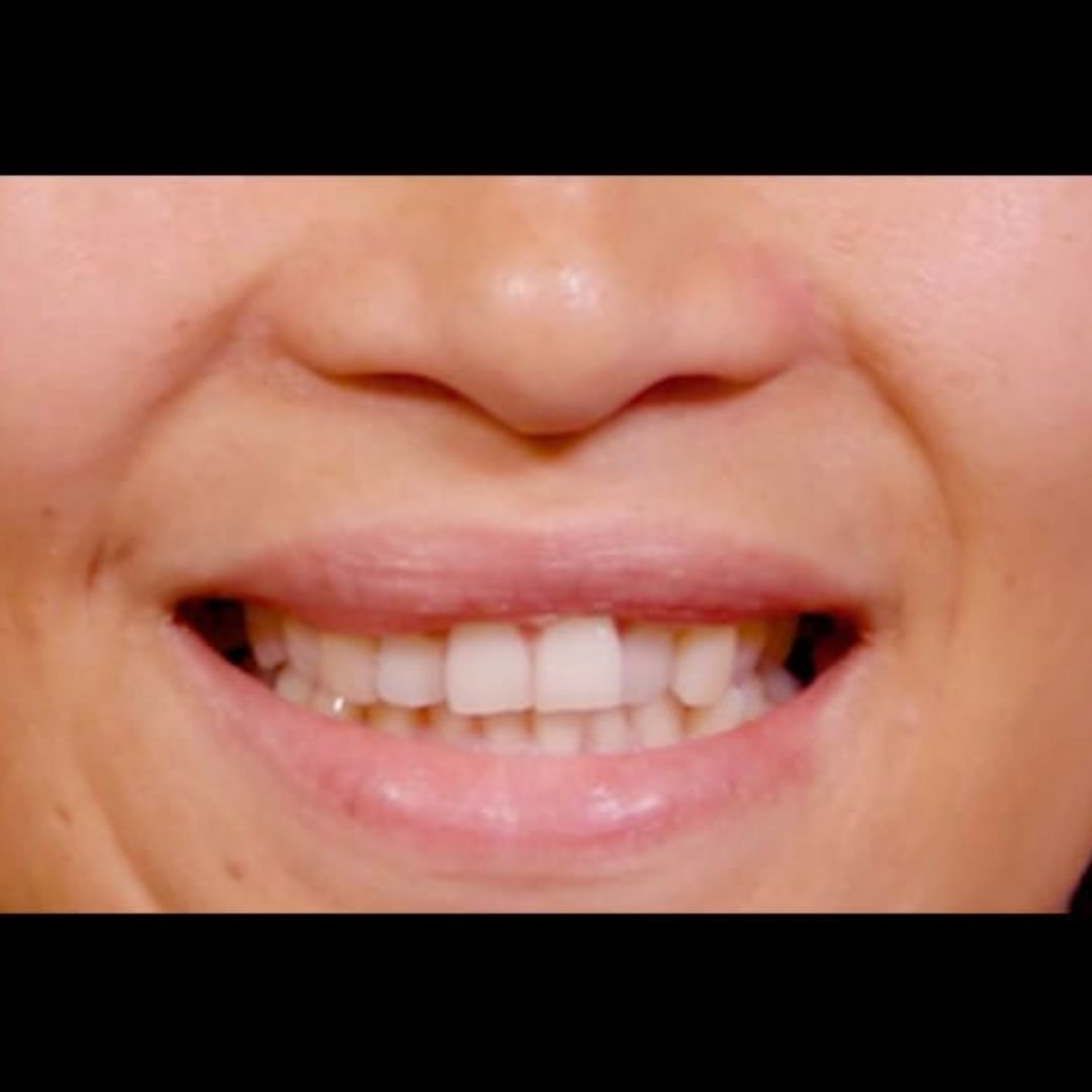 gummy smile treatment after