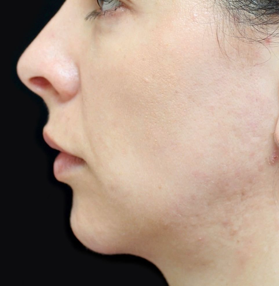 jawline filler after treatment