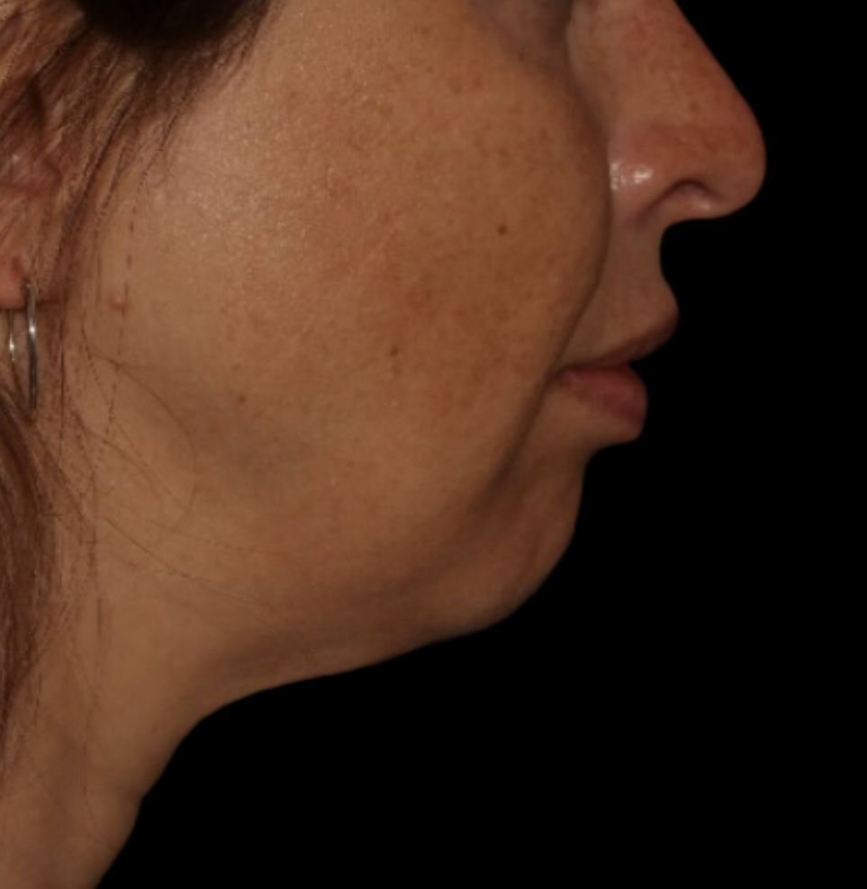 jawline filler london before