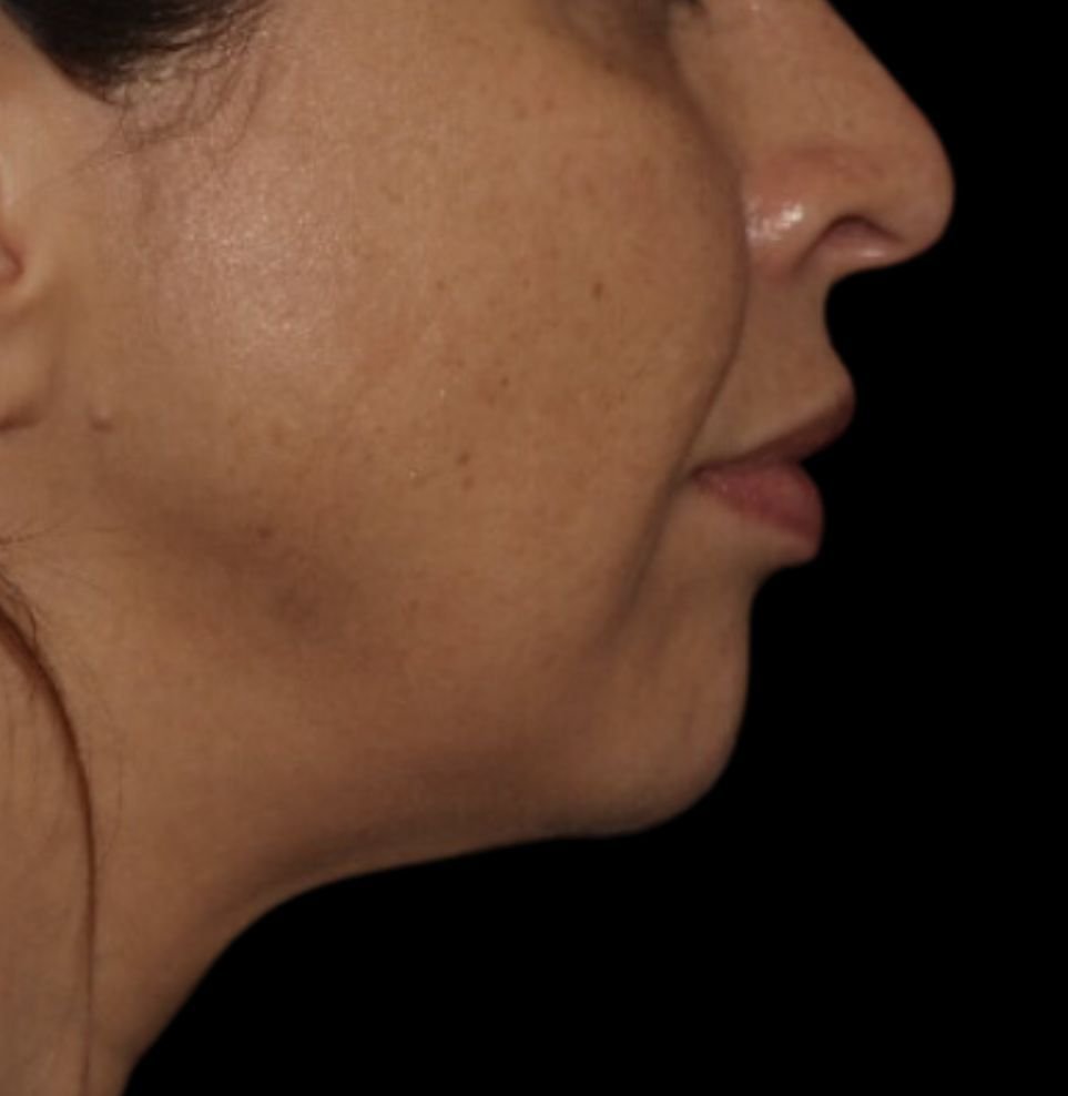 jawline filler london after