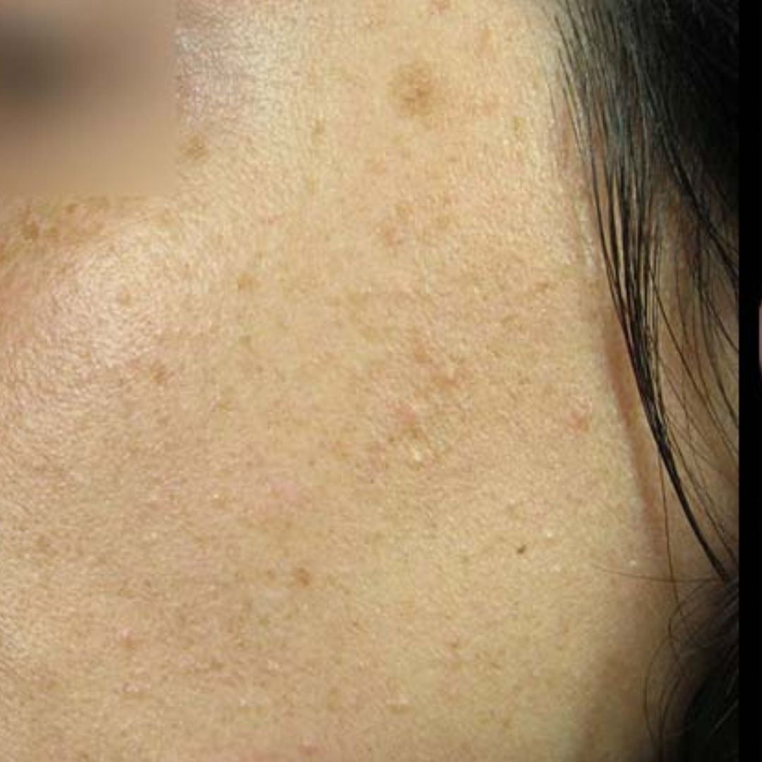 age spot pigmentation london treatment before