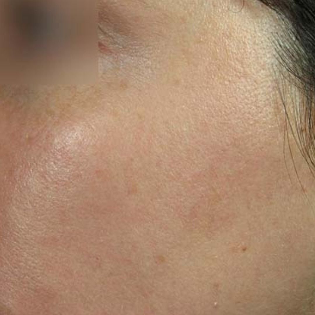 age spot pigmentation london treatment after