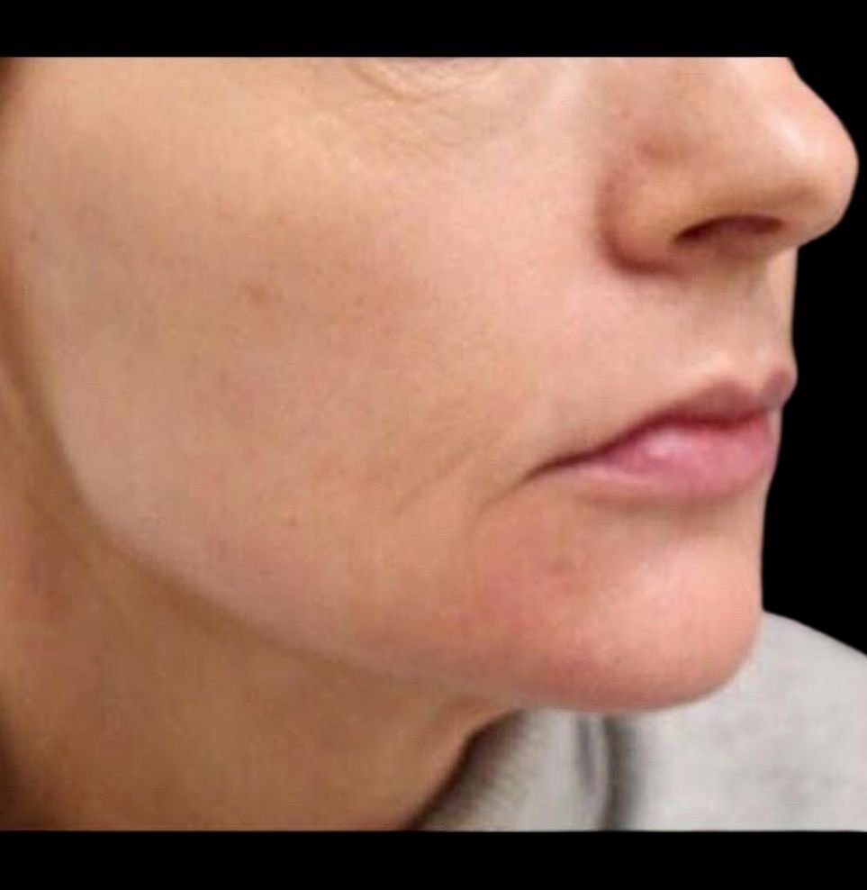 jawline filler after