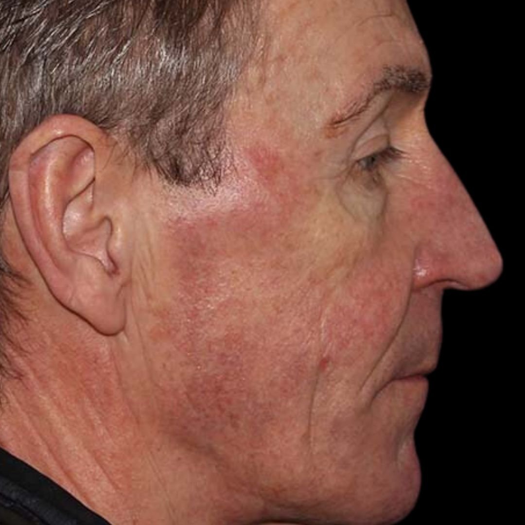 age spot pigmentation treatment before