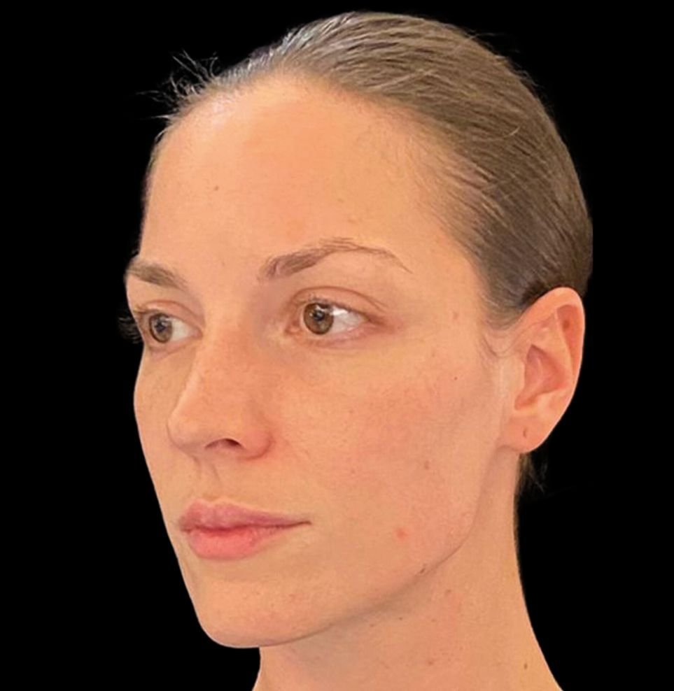 non-surgical facelift after