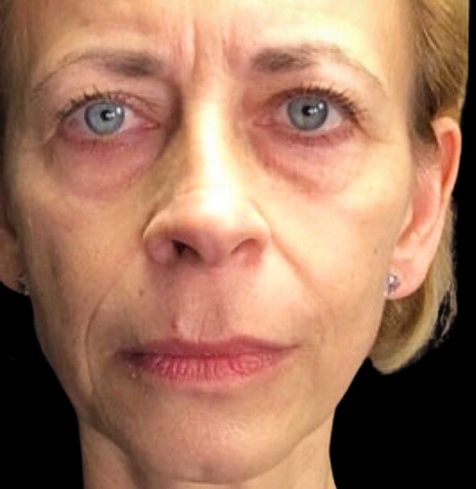 non-surgical facelift before