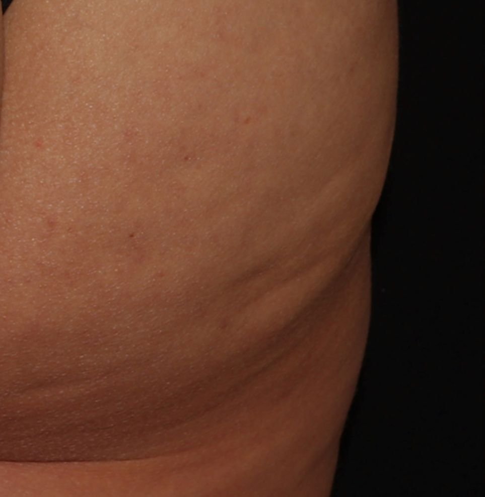 cellulite buttocks endolift treatment before